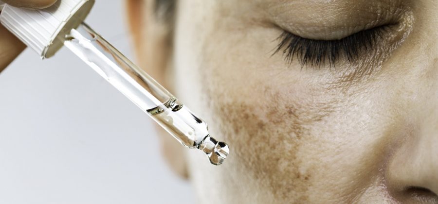 Everything you need to know about hyperpigmentation