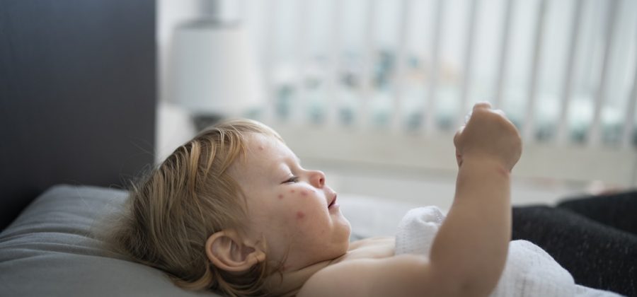 How to treat chickenpox with PoxClin Cool Mousse