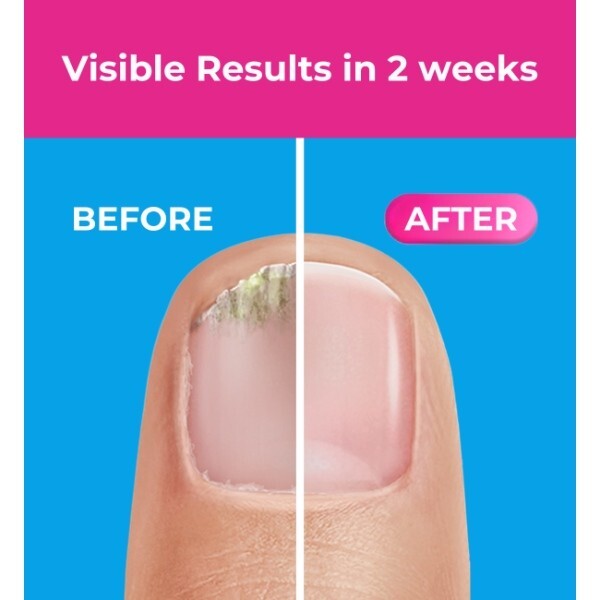 Excilor Fungal Nail Pen 4ml